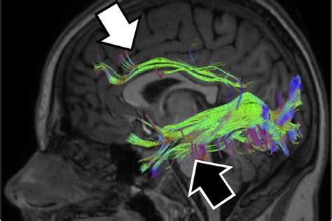 Cortical Visual Impairment vs. Cerebral Visual Impairment – Perkins ...