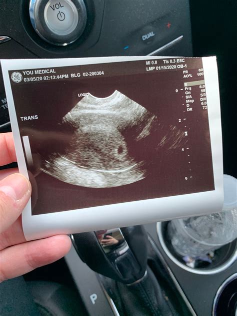 4 Week Ultrasound Pictures