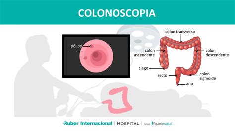 Colonoscopia: Clave en la detección precoz del cáncer colon