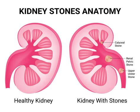 Kidney Stones Anatomy Science Design Illustration Diagram 46452131 ...