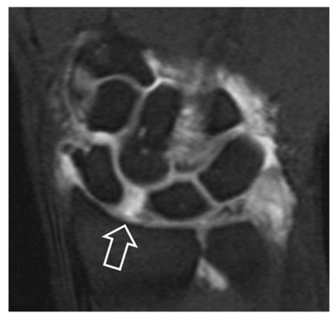 SLAC and SNAC Wrist: The Top Five Things That General Radiologists Need ...