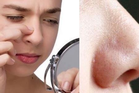 【图】谈谈鼻子上长痘痘是什么原因 我们不能无视它_鼻子_伊秀美容网|yxlady.com
