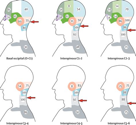 Cervicogenic headache: an assessment of the evidence on clinical ...