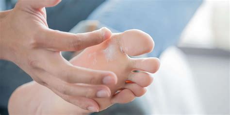 Athlete’s Foot: Symptoms, Causes & Treatment | Katy Foot Care