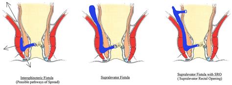 Classificacao De Fistula Perianal Fazendo Cirurgia Fístula Perianal