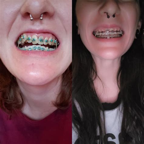 I Got Braces at 60 Years Old, and My Smile’s Never Looked Better HD Wallpaper