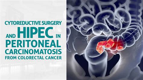 AIS Channel · Cytoreductive surgery and HIPEC in peritoneal carcinomatosis from colorectal ...