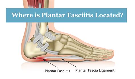 Plantar Fasciitis Treatment in Frisco| Heel Pain | RNV Podiatry