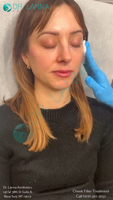 How to Manage Swelling Under Eye After Cheek Filler: Your Comprehensive Guide | Doctor Lanna