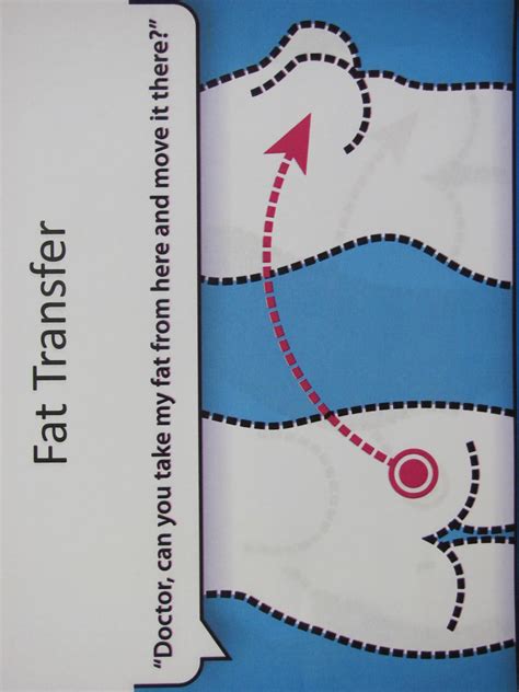 Fat Transfer Breast Augmentation - Breast Implants Information Blog