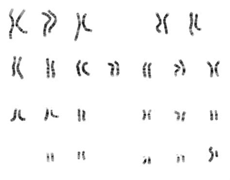 Chromosome Testing | Concise Medical Knowledge