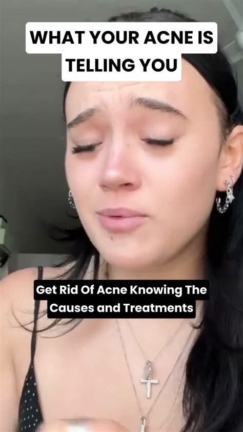 What to know about acne face mapping | Curology | Pimples on face ...