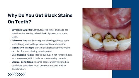 How To Remove Black Stains from Teeth Naturally - Green Valley Smile Care, Henderson, NV | PPT