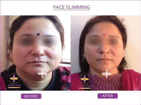 Face Slimming Treatment | Delhi | Dr Syed