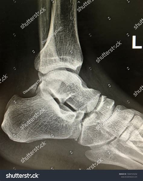 Film Xray Lateral Ankle Showed Fracture Stock Photo 1504723232 ...