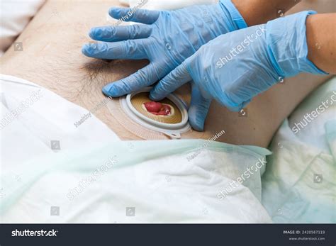 Close Stoma Colostomy After Colon Cancer Stock Photo 2420567119 ...