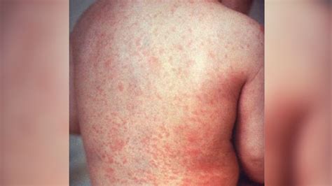 Measles outbreak in UP village, three children die
