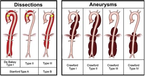Perioperative management of thoracic and thoracoabdominal aneurysms ...