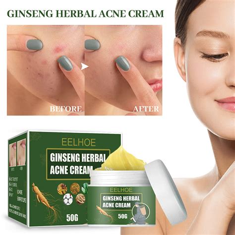 Crema para eliminar el acné, 50g, Control de aceite, blanqueamiento, hidratación, marcas de acné ...