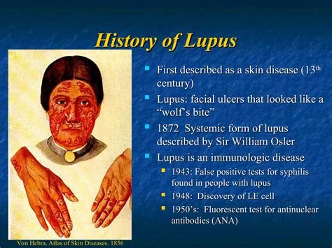 When Was Lupus Discovered