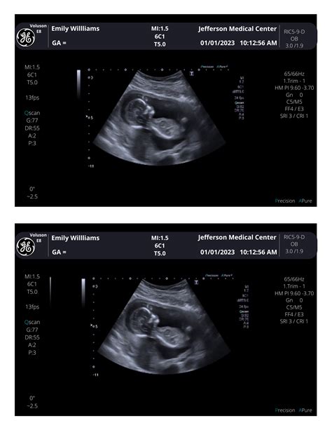 Personalized Fake Ultrasound Sonogram Picture!! From 3-40 weeks! – creetify