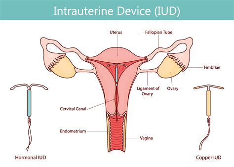 IUD Insertion Pain: What To Expect and How to Manage It | University of ...
