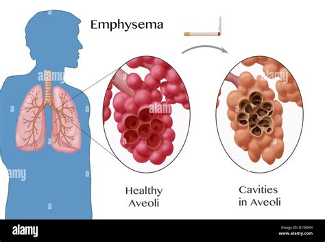 End Stage of Emphysema 的图像结果