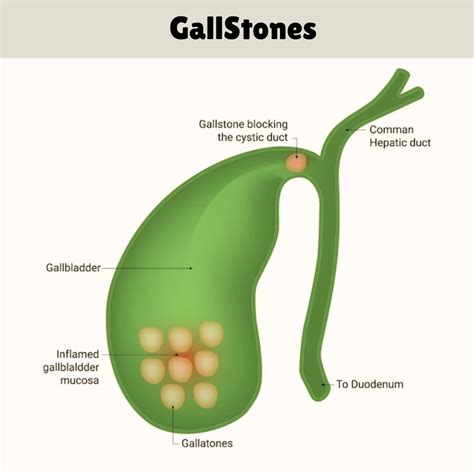 Image result for Gallbladder Test