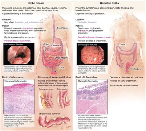 Ulcerative Colitis Vs Crohns Disease Inflammatory Bowel Disease