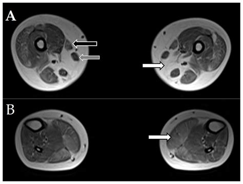 Pathogenic Mutations and Putative Phenotype-Affecting Variants in ...