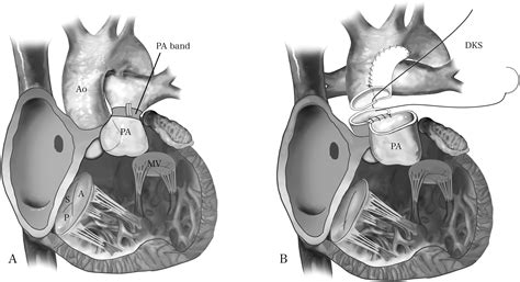 Staged Ventricular Septation in Patients With Double Inlet Ventricle - Operative Techniques in ...