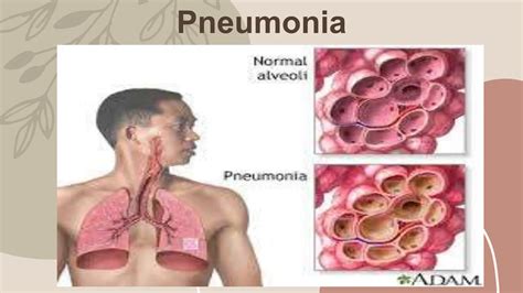 pneumonia , definition, causes , clinical manifestation, management.pptx