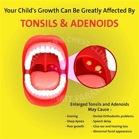 Enlarged Tonsils and Adenoids in Children: diagnosis & treatment – Dr ...