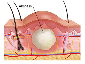 Infected Abscess Lanced 的图像结果