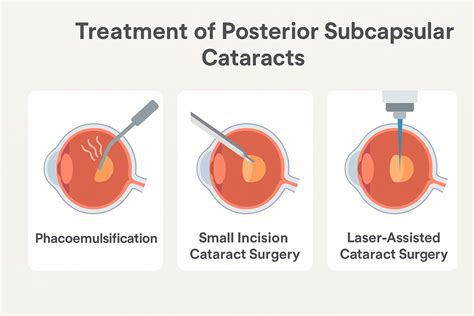 Posterior subcapsular cataract: Description and causes - Laxmi Eye Hospital