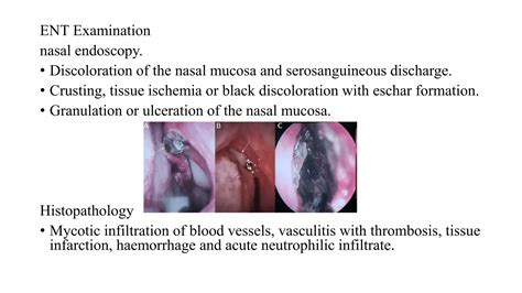 FUNGAL RHINOSINUSITIS - invasive fungal sinusitis.pptx