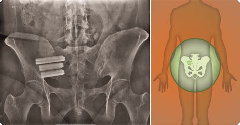 Aptiva Health: Sacroiliac (SI) Joint Fusion | Aptiva Health