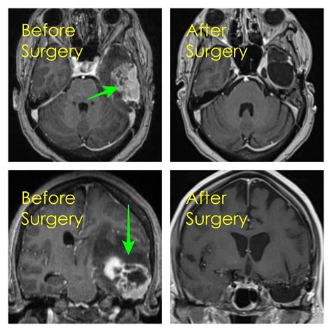 Brain Tumor Removal