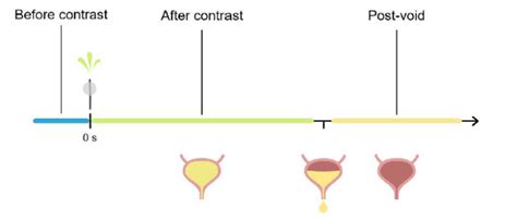 Image result for Cystogram Procedure for CT Scan