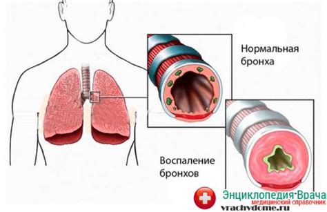 Как вылечить астму навсегда в домашних условиях – основные методы