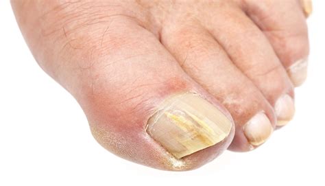 How Fungal Nail Infections Are Treated and Diagnosed