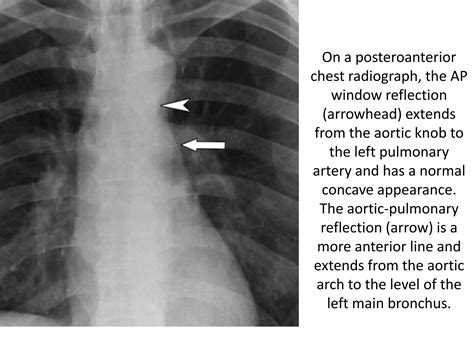 Mediastinum-RADIOLOGY | PPTX