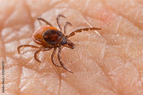 Image result for Embedded Deer Tick