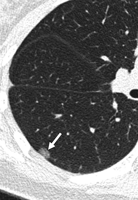 Ground-Glass Nodules on Chest CT as Imaging Biomarkers in the Management of Lung Adenocarcinoma ...