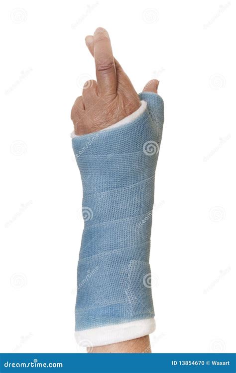 Broken Finger Cast