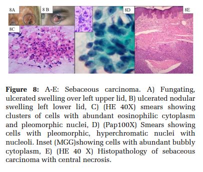 Role of Aspiration Cytology in Intraocular and Periorbital Adnexal Lesions