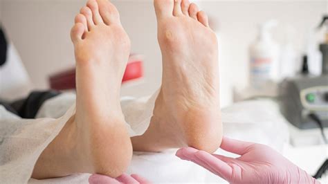 What Causes the Bottom of Your Feet to Turn Yellow? | OnlyMyHealth