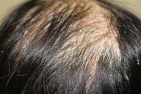 Scalp Psoriasis Hair Loss