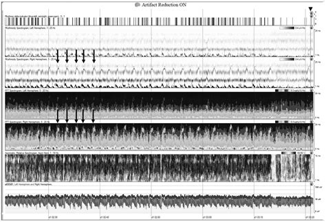 Electroencephalogram Monitoring in Critical Care - PMC