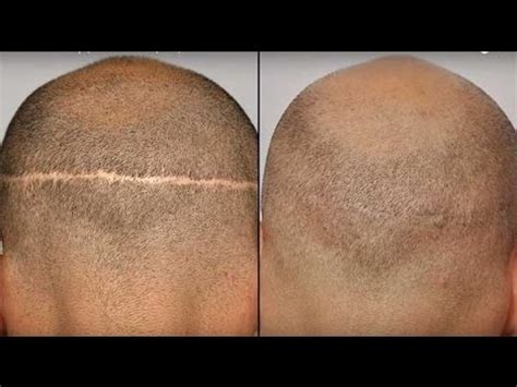 Hair Scar repair, Hair surgery scars, Hair Transplant Scar Revision FUE FUT